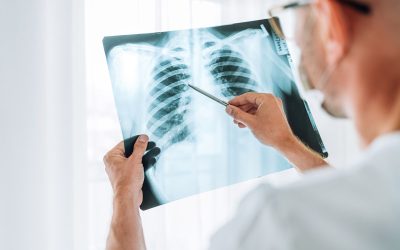 What Employers Should Know About TB Testing